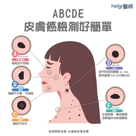 臉頰長痣|皮膚長痣、長斑是皮膚癌前兆？皮膚癌初期4大症狀快。